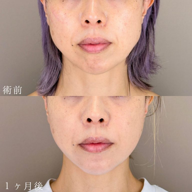 顔の脂肪吸引(担当医:山本 展生 医師)の症例写真1