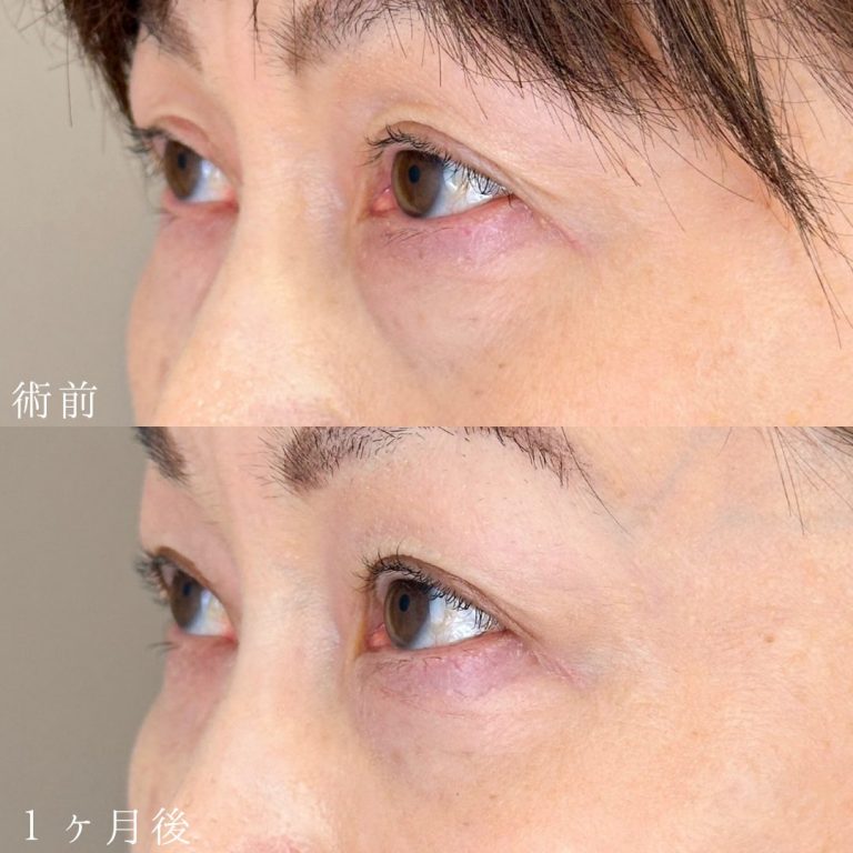 切らない目の下のクマ取り・目の下のたるみ（ふくらみ）取り(担当医:山本 展生 医師)の症例写真1