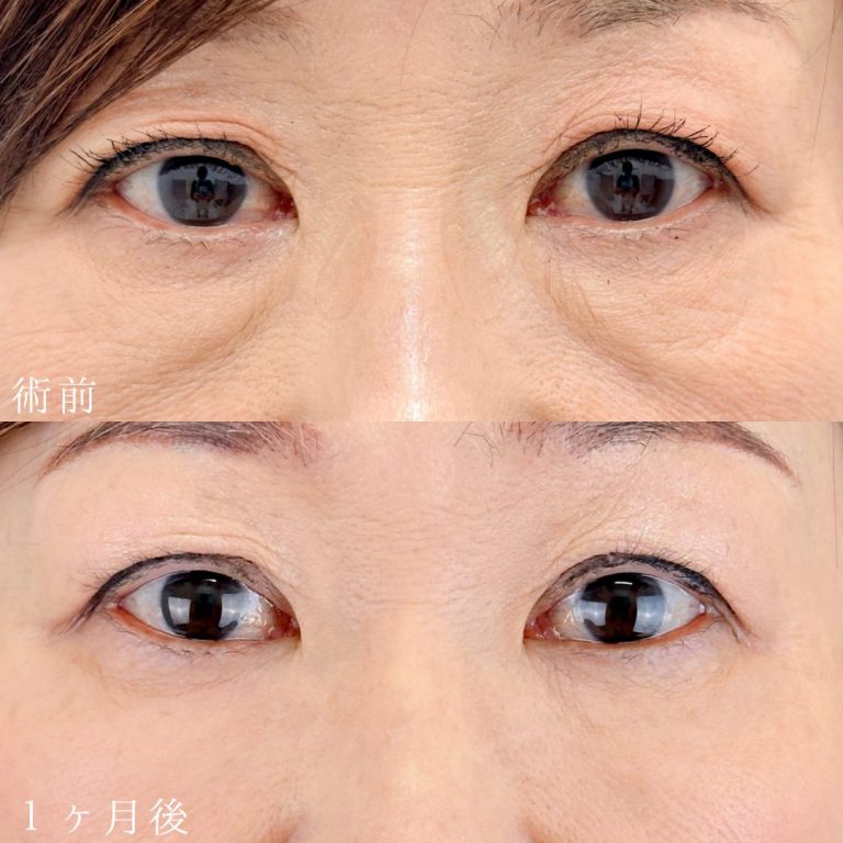 切らない目の下のクマ取り・目の下のたるみ（ふくらみ）取り(担当医:山本 展生 医師)の症例写真1