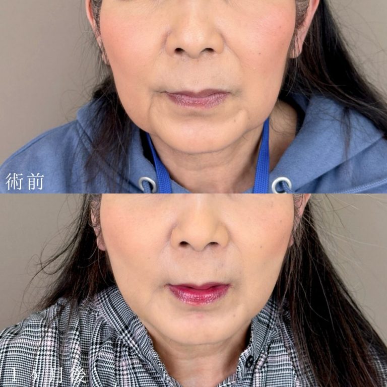 小顔美肌再生（リフトアップ）(担当医:山本 展生 医師)の症例写真1