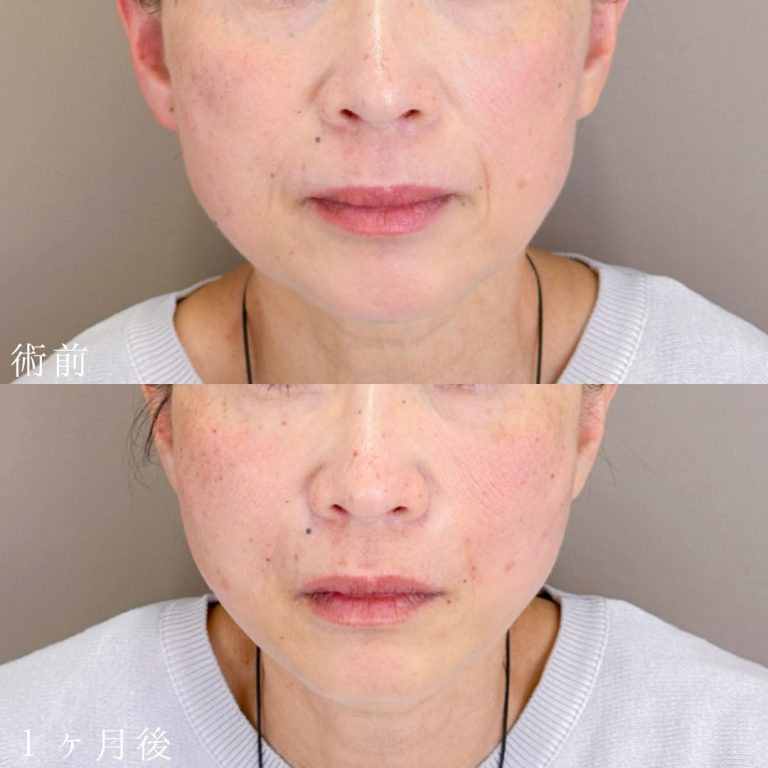 小顔美肌再生（リフトアップ）(担当医:山本 展生 医師)の症例写真1