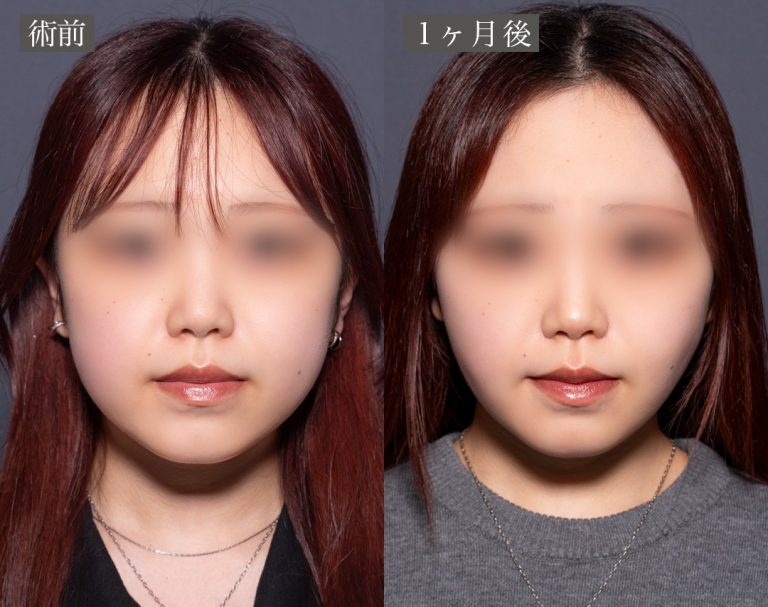 顔の脂肪吸引(担当医:岡本 卓也 医師)の症例写真1