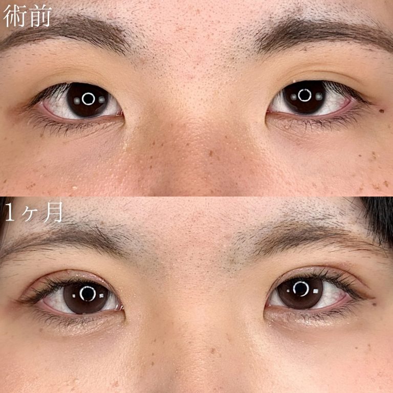 二重埋没法(担当医:川原田 元亨 医師)の症例写真1