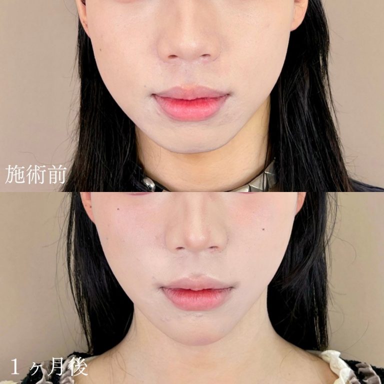 小顔美肌再生（リフトアップ）(担当医:山本 展生 医師)の症例写真1