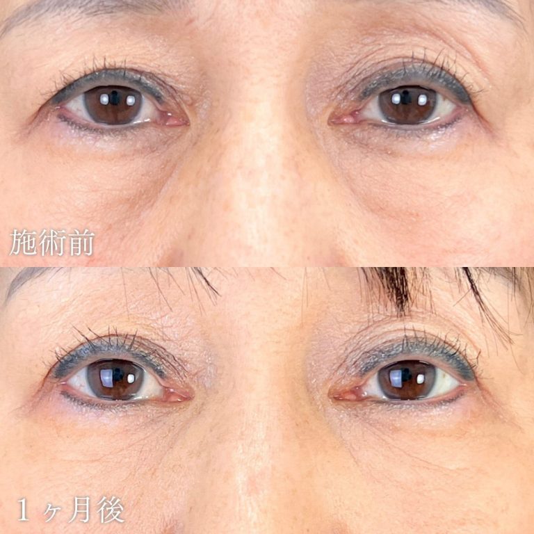 切らない目の下のクマ取り・目の下のたるみ（ふくらみ）取り(担当医:山本 展生 医師)の症例写真1