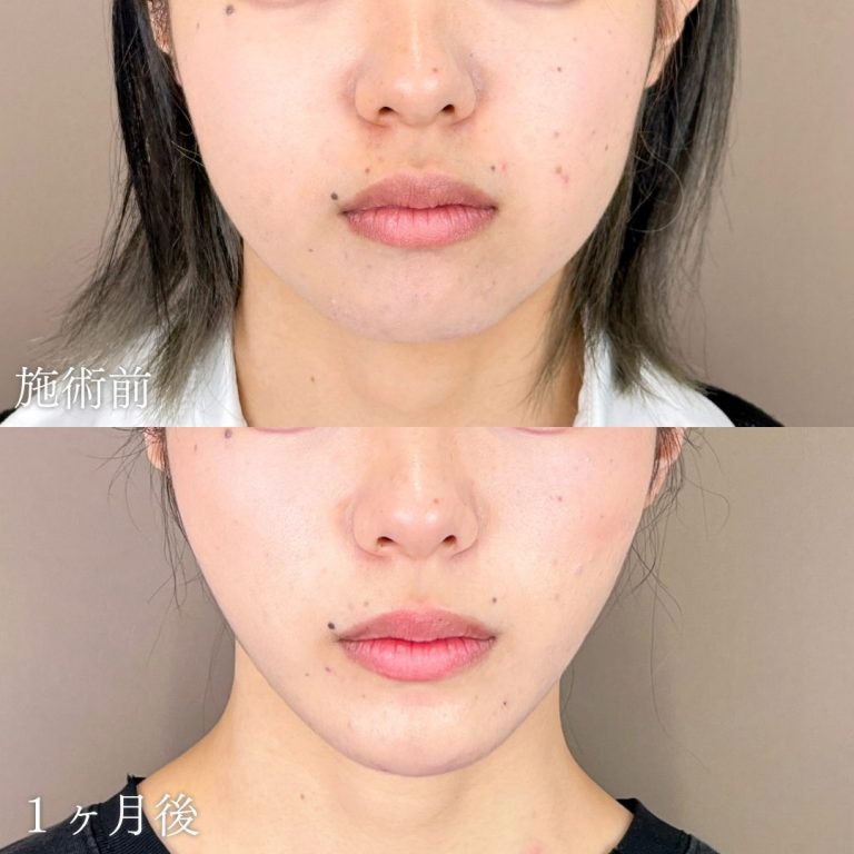顔の脂肪吸引(担当医:山本 展生 医師)の症例写真1