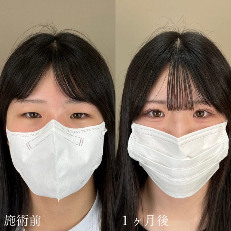 二重埋没法(担当医:山本 展生 医師)の症例写真1