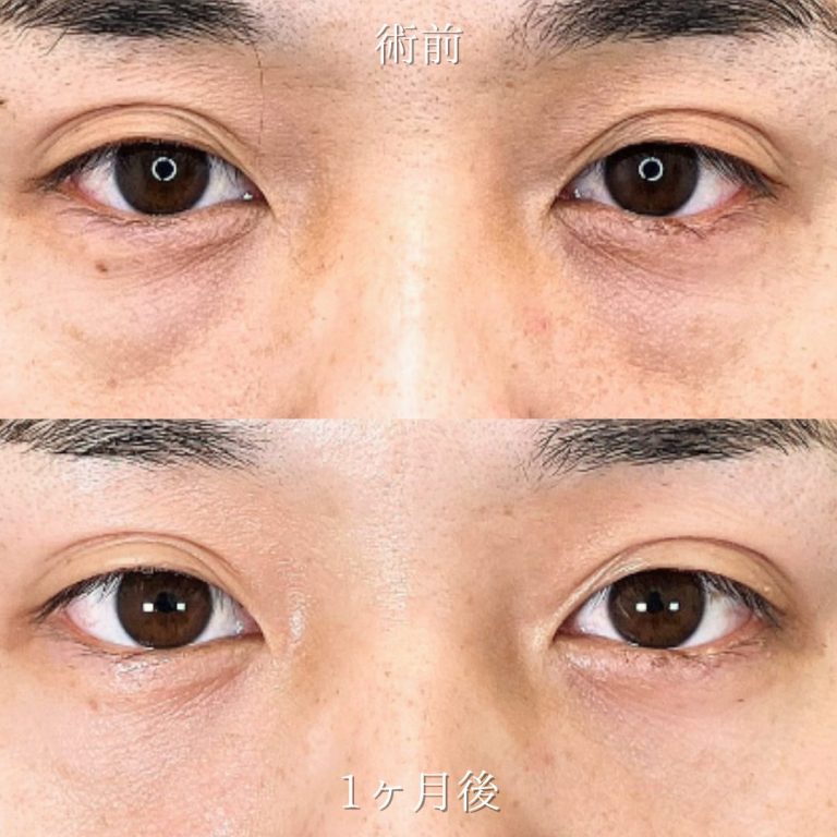 切らない目の下のクマ取り・目の下のたるみ（ふくらみ）取り(担当医:山田 亮 医師)の症例写真1
