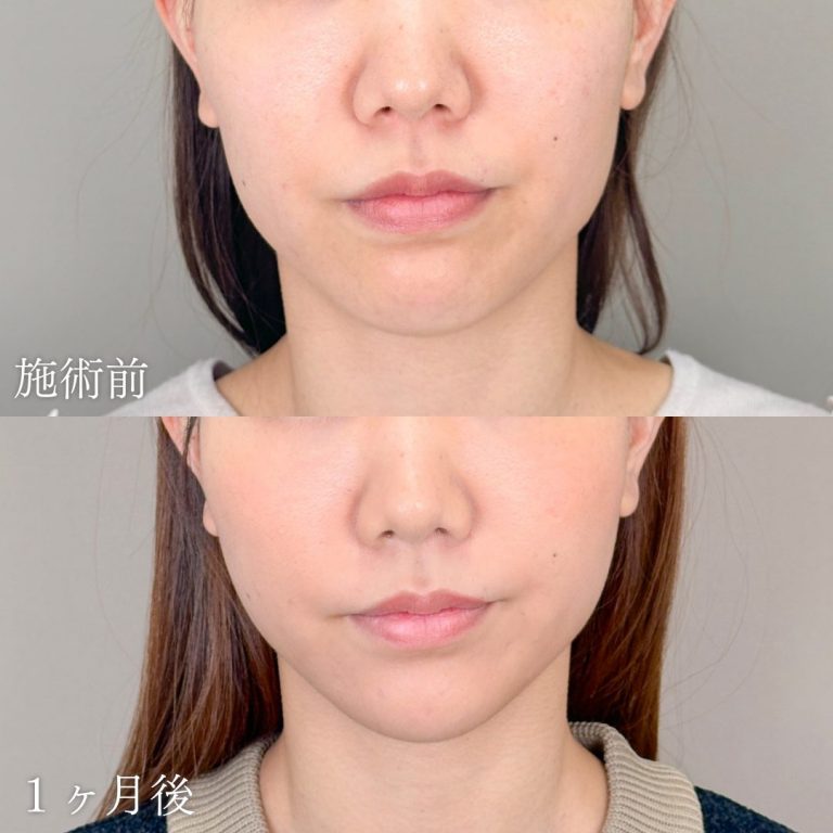 小顔美肌再生（リフトアップ）(担当医:山本 展生 医師)の症例写真1