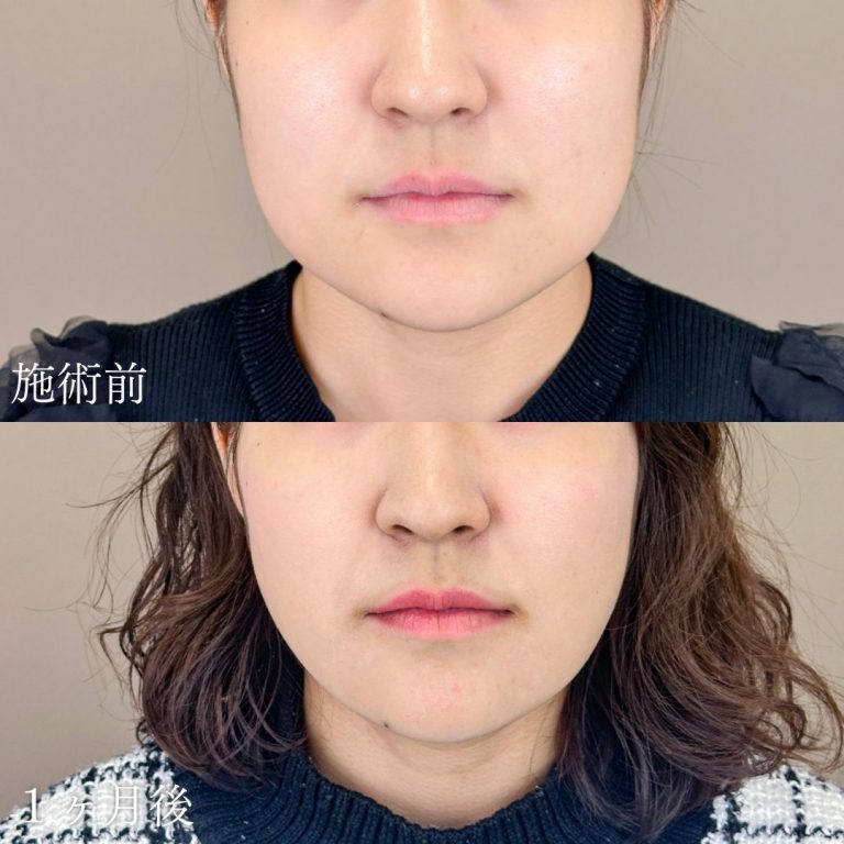 顔の脂肪吸引(担当医:山本 展生 医師)の症例写真1