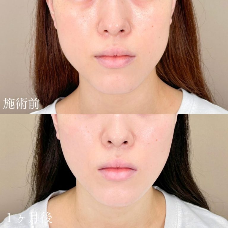 小顔美肌再生（リフトアップ）(担当医:山本 展生 医師)の症例写真1