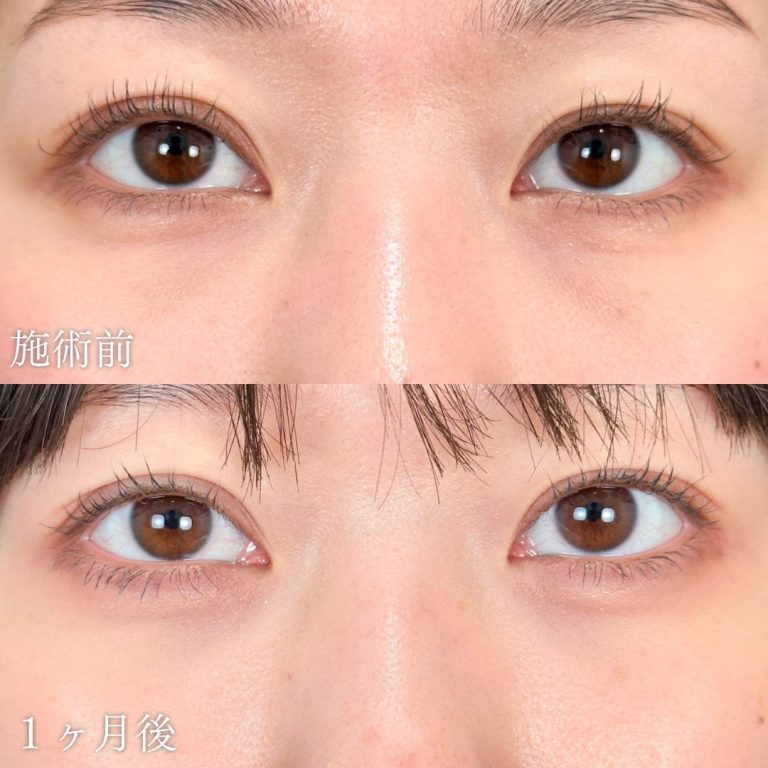 切らない目の下のクマ取り・目の下のたるみ（ふくらみ）取り(担当医:山本 展生 医師)の症例写真1