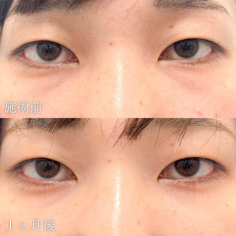 切らない目の下のクマ取り・目の下のたるみ（ふくらみ）取り(担当医:山本 展生 医師)の症例写真1