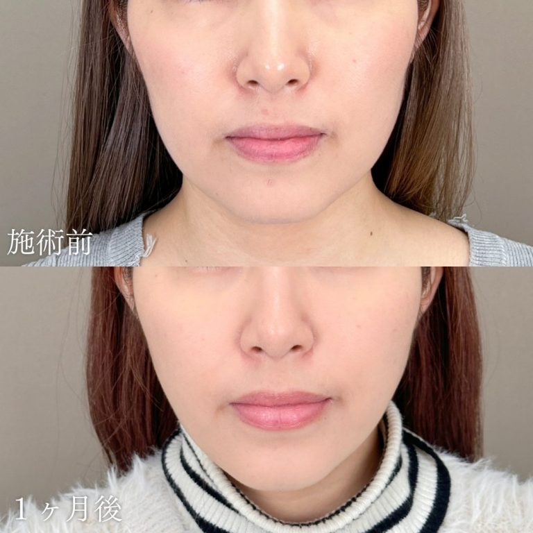 顔の脂肪吸引(担当医:山本 展生 医師)の症例写真1