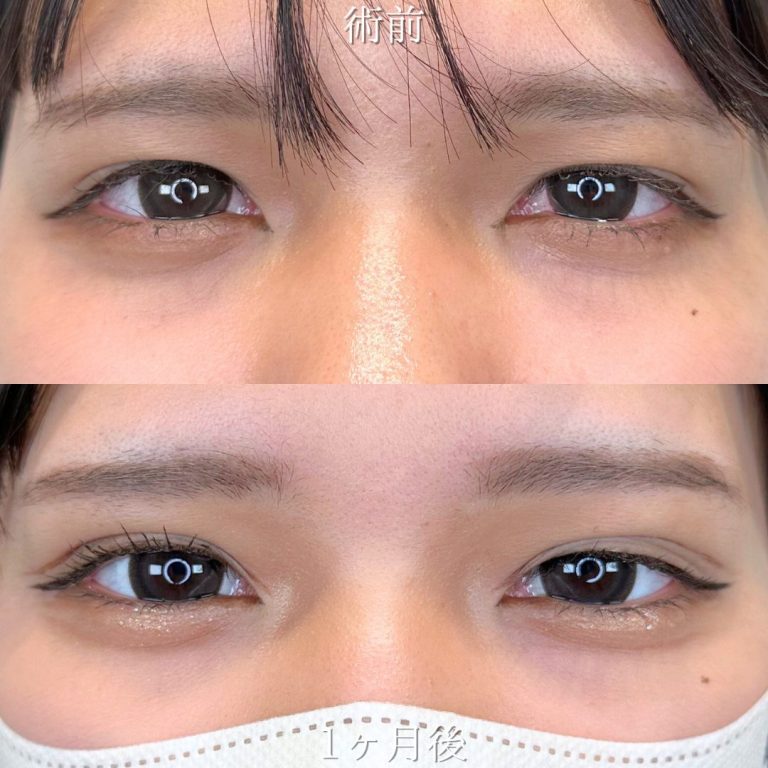 二重埋没法(担当医:山田 亮 医師)の症例写真1