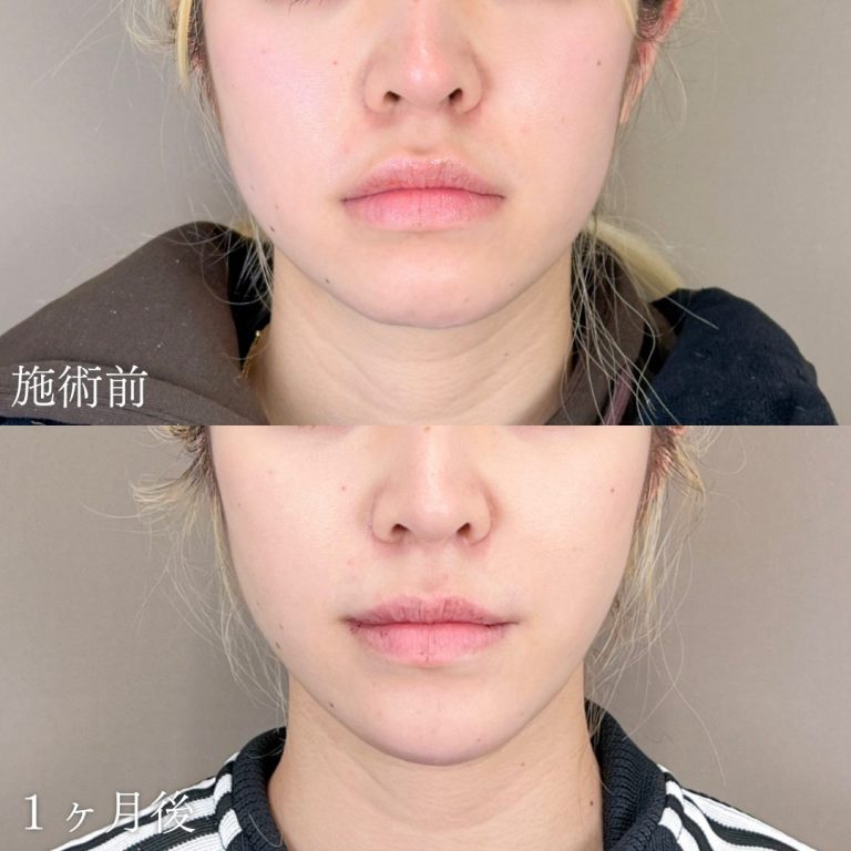 顔の脂肪吸引(担当医:山本 展生 医師)の症例写真1