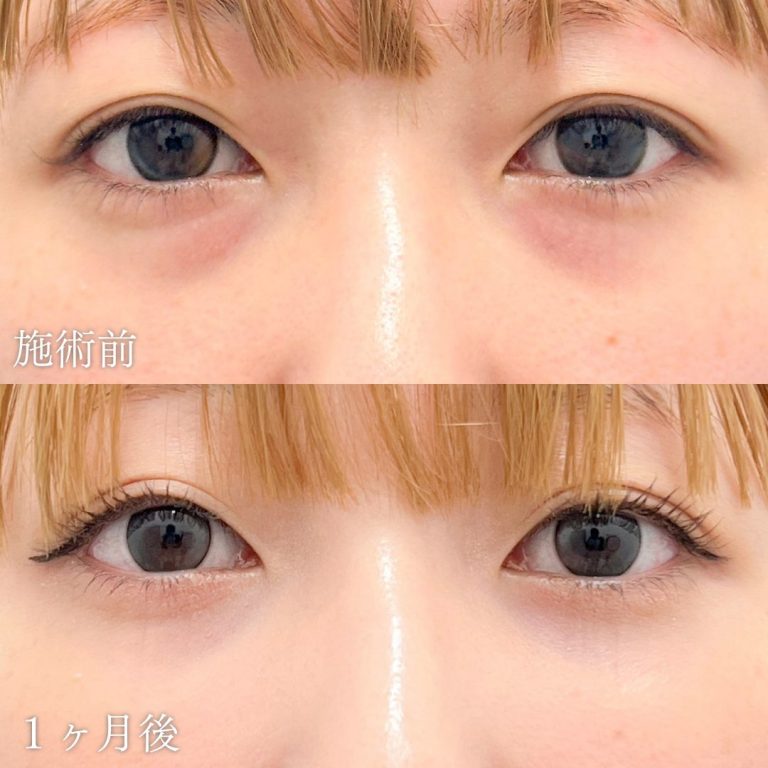 切らない目の下のクマ取り・目の下のたるみ（ふくらみ）取り(担当医:山本 展生 医師)の症例写真1