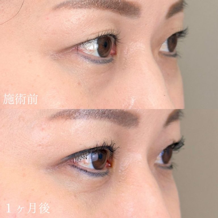 切らない目の下のクマ取り・目の下のたるみ（ふくらみ）取り(担当医:山本 展生 医師)の症例写真1
