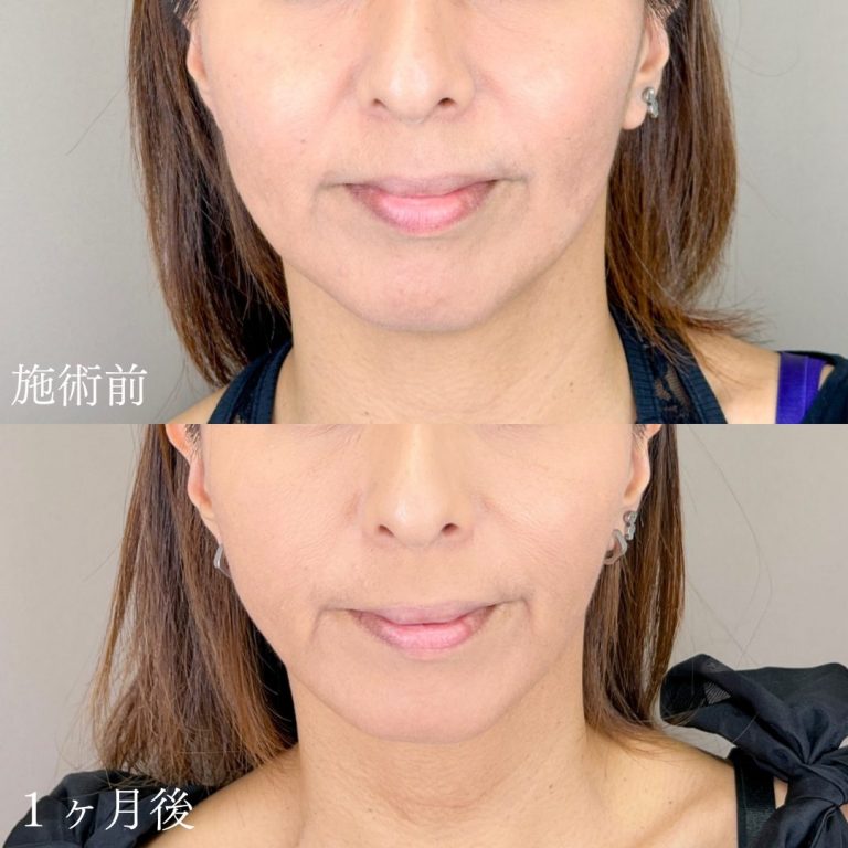 顔の脂肪吸引(担当医:山本 展生 医師)の症例写真1