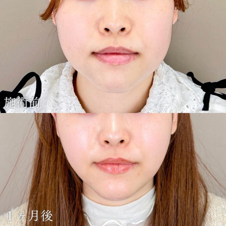 顔の脂肪吸引(担当医:山本 展生 医師)の症例写真1