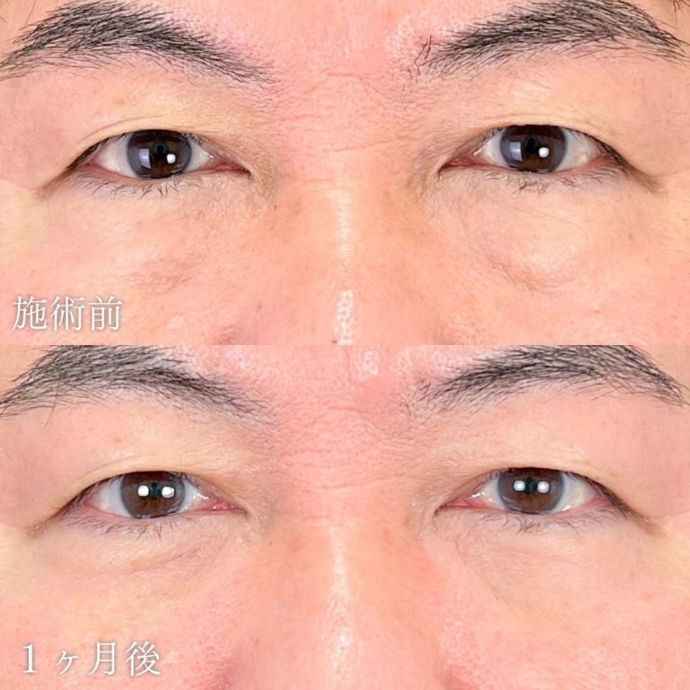 切らない目の下のクマ取り・目の下のたるみ（ふくらみ）取り(担当医:山本 展生 医師)の症例写真1