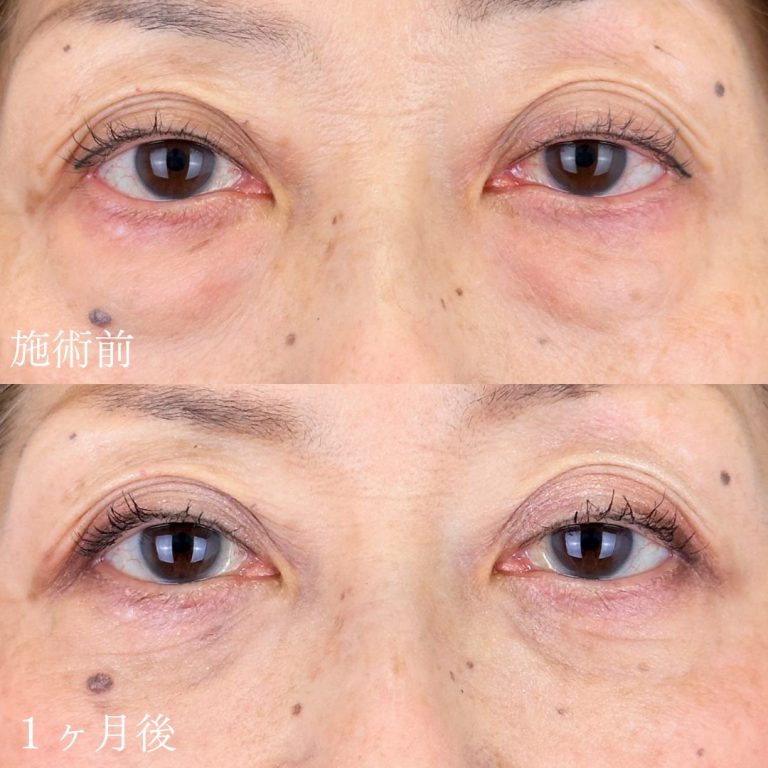 切らない目の下のクマ取り・目の下のたるみ（ふくらみ）取り(担当医:山本 展生 医師)の症例写真1