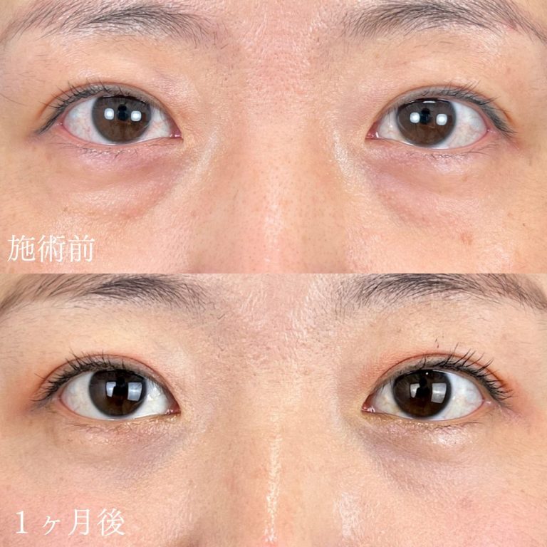 切らない目の下のクマ取り・目の下のたるみ（ふくらみ）取り(担当医:山本 展生 医師)の症例写真1