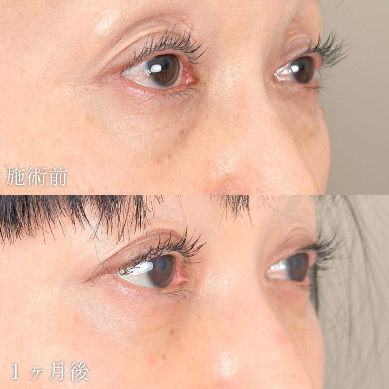 切らない目の下のクマ取り・目の下のたるみ（ふくらみ）取り(担当医:山本 展生 医師)の症例写真1