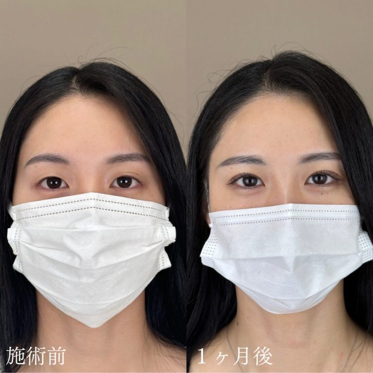 二重埋没法(担当医:山本 展生 医師)の症例写真1