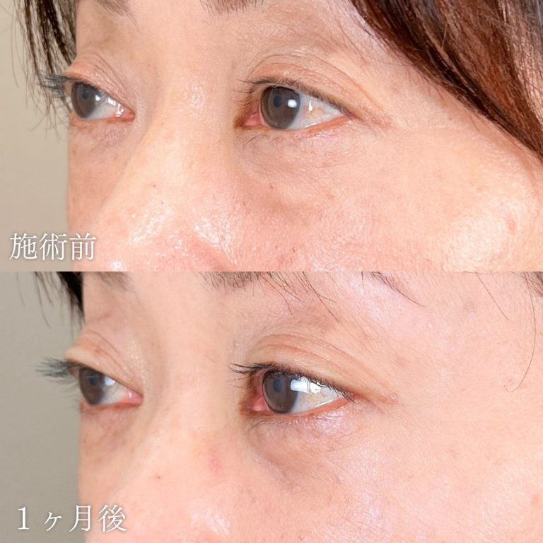 切らない目の下のクマ取り・目の下のたるみ（ふくらみ）取り(担当医:山本 展生 医師)の症例写真1