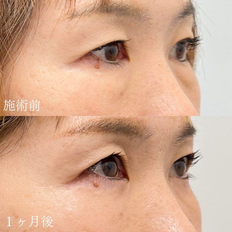 切らない目の下のクマ取り・目の下のたるみ（ふくらみ）取り(担当医:山本 展生 医師)の症例写真1