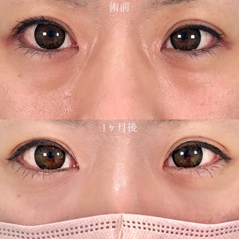 切らない目の下のクマ取り・目の下のたるみ（ふくらみ）取り(担当医:山口 征大 医師)の症例写真1