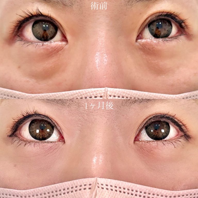 切らない目の下のクマ取り・目の下のたるみ（ふくらみ）取り(担当医:山口 征大 医師)の症例写真2