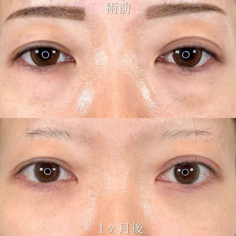 切らない目の下のクマ取り・目の下のたるみ（ふくらみ）取り(担当医:山田 亮 医師)の症例写真1