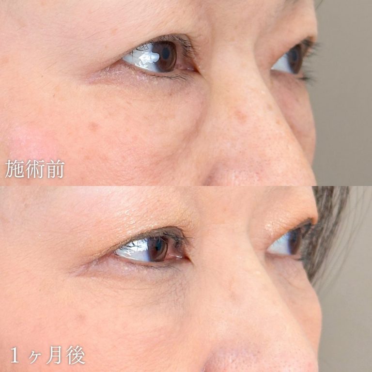 切らない目の下のクマ取り・目の下のたるみ（ふくらみ）取り(担当医:山本 展生 医師)の症例写真1