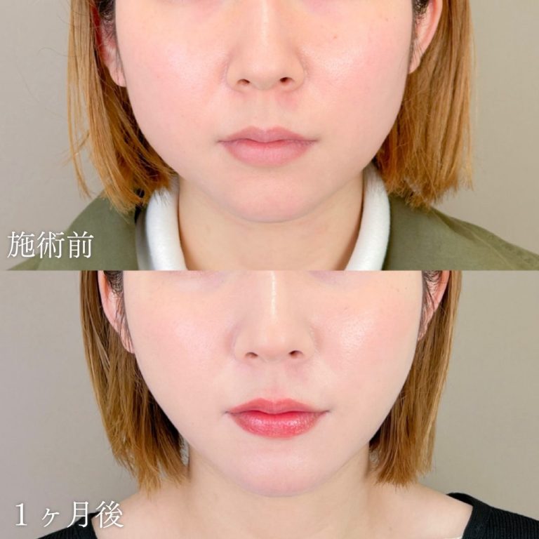 顔の脂肪吸引(担当医:山本 展生 医師)の症例写真1