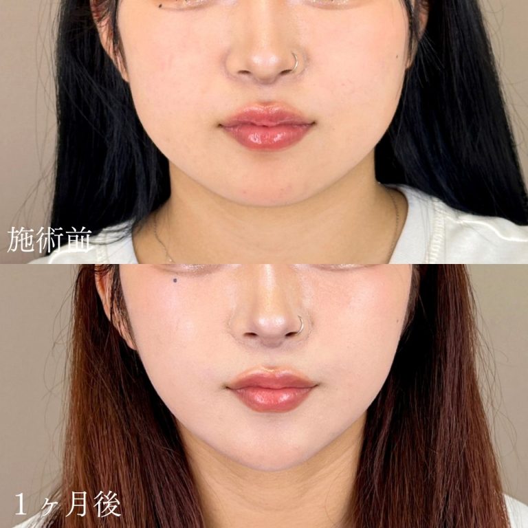 顔の脂肪吸引(担当医:山本 展生 医師)の症例写真1