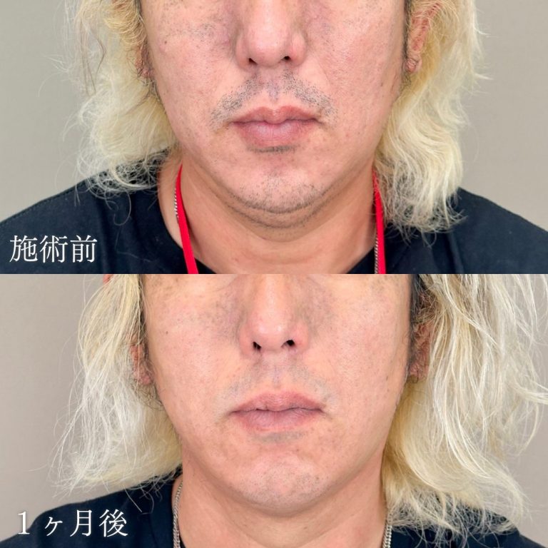 顔の脂肪吸引(担当医:山本 展生 医師)の症例写真1
