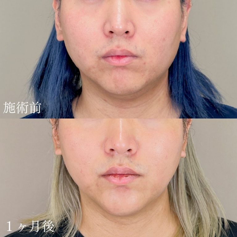 顔の脂肪吸引(担当医:山本 展生 医師)の症例写真1