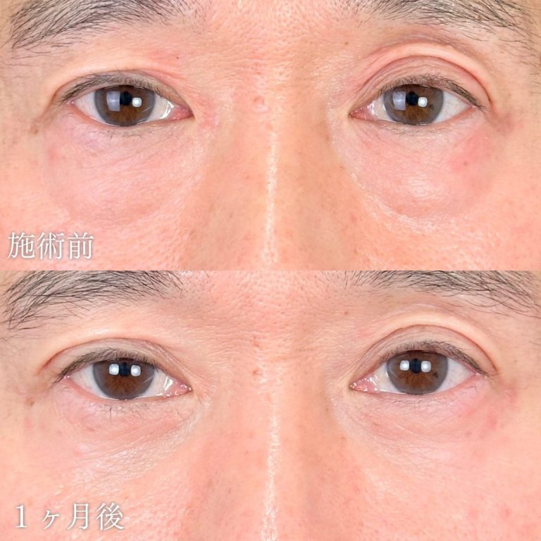 切らない目の下のクマ取り・目の下のたるみ（ふくらみ）取り(担当医:山本 展生 医師)の症例写真1