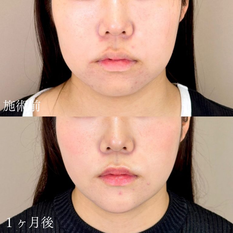顔の脂肪吸引(担当医:山本 展生 医師)の症例写真1