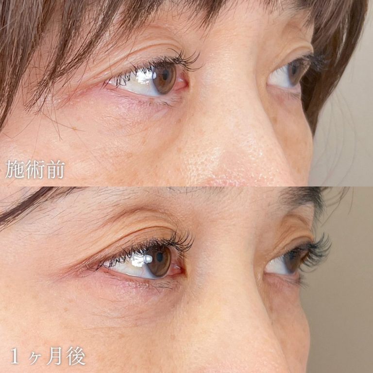 切らない目の下のクマ取り・目の下のたるみ（ふくらみ）取り(担当医:山本 展生 医師)の症例写真1