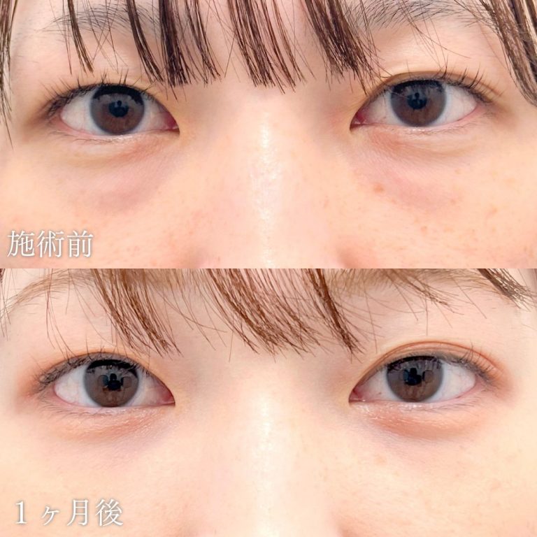 切らない目の下のクマ取り・目の下のたるみ（ふくらみ）取り(担当医:山本 展生 医師)の症例写真1