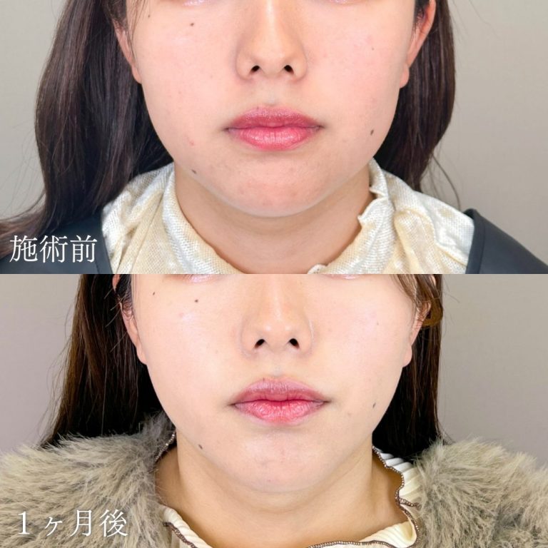 顔の脂肪吸引(担当医:山本 展生 医師)の症例写真1