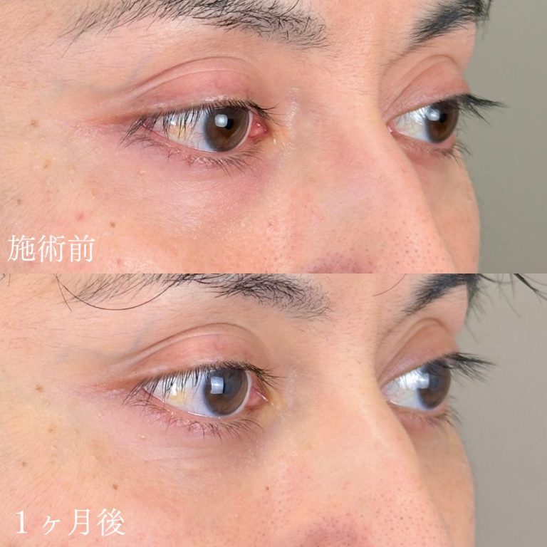 切らない目の下のクマ取り・目の下のたるみ（ふくらみ）取り(担当医:山本 展生 医師)の症例写真1