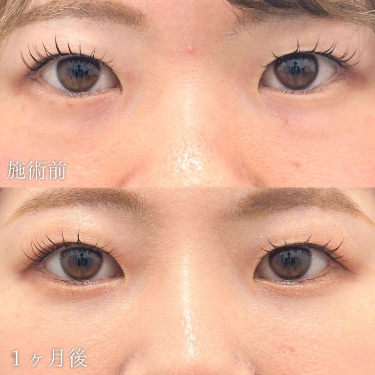 切らない目の下のクマ取り・目の下のたるみ（ふくらみ）取り(担当医:山本 展生 医師)の症例写真1