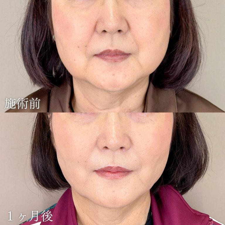 顔の脂肪吸引(担当医:山本 展生 医師)の症例写真1