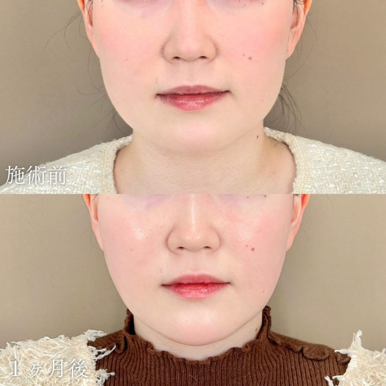 顔の脂肪吸引(担当医:山本 展生 医師)の症例写真1