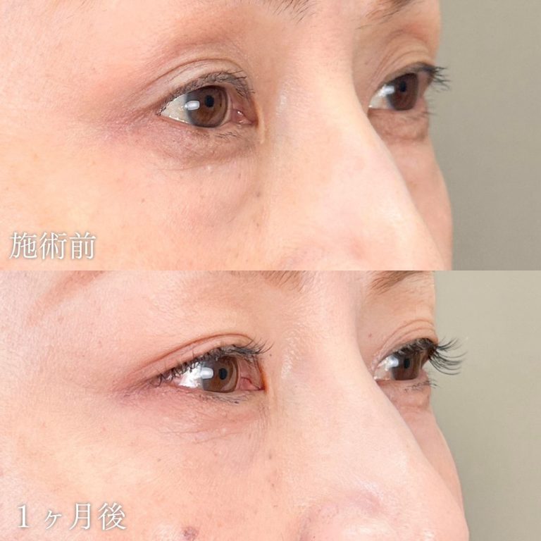 切らない目の下のクマ取り・目の下のたるみ（ふくらみ）取り(担当医:山本 展生 医師)の症例写真1