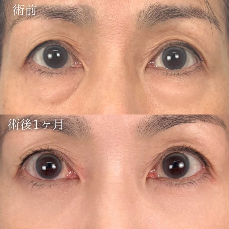 切らない目の下のクマ取り・目の下のたるみ（ふくらみ）取り(担当医:奥田 真吾 医師)の症例写真1